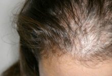 Riaperti i termini dell’avviso per l’acquisto di parrucche per  le donne con alopecia da chemioterapia