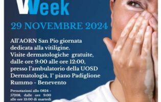 Al San Pio di Benevento open day sulla Vitiligine